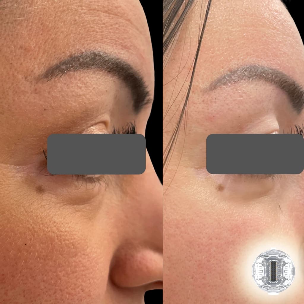 M-18 microneedling RF applicator
