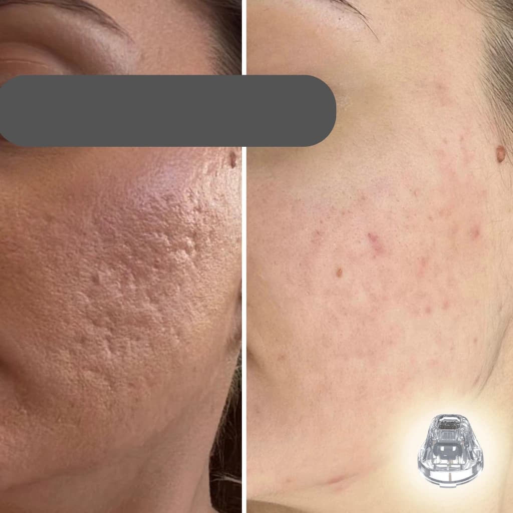 M-25 microneedling RF applicator