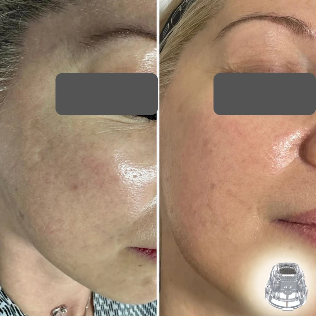 M-49 microneedling RF applicator