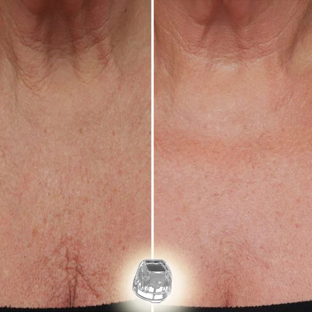 M-81 microneedling RF applicator