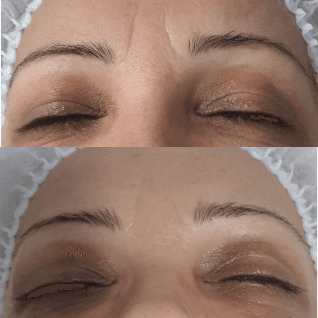 Reduced fine lines