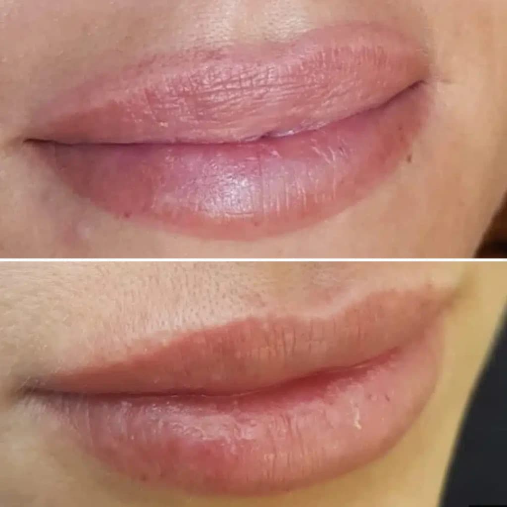 PICO Glow permanent lip makeup removal before and after
