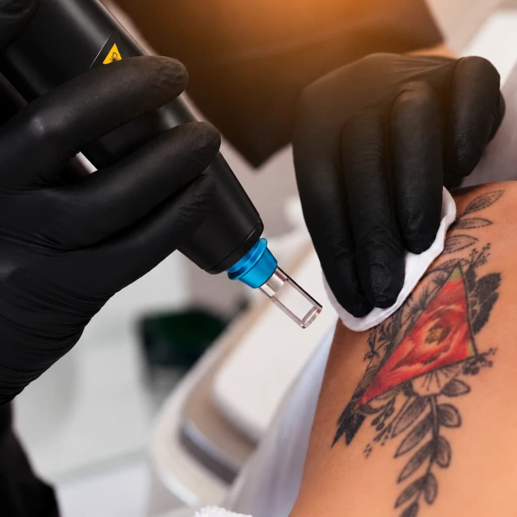 PICO Glow tattoo removal treatment