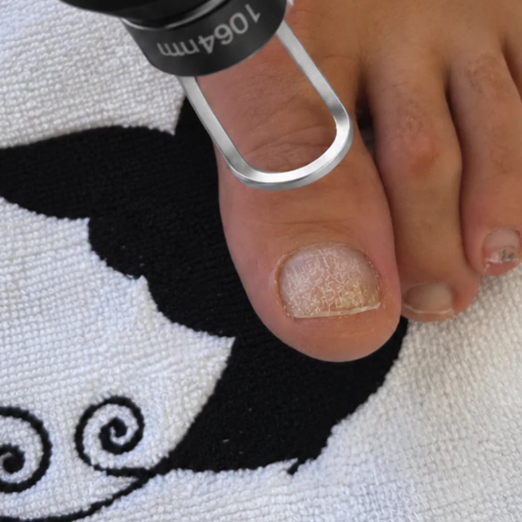 PICO Glow treatment of fungal nail changes